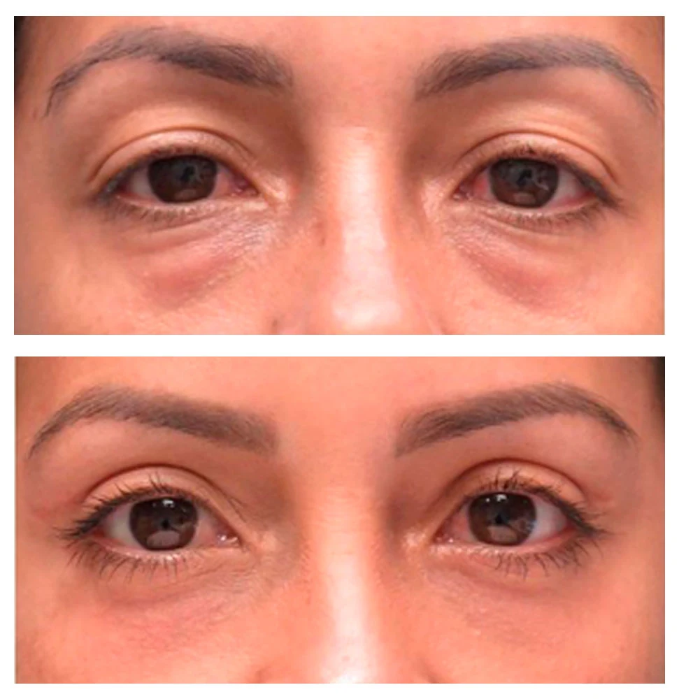 Antes e depois 01 · resultado real