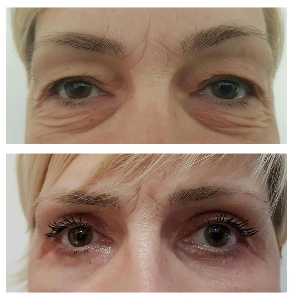 Antes e depois 06 · resultado real